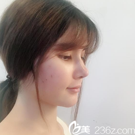 广州紫馨易东风隆鼻手术15天效果图