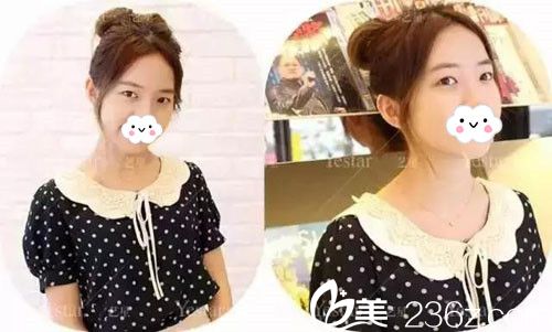 术前单眼皮+肿泡眼 术前单眼皮+肿泡眼