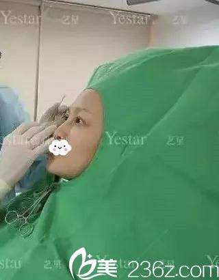 做双眼皮术前划线设计 做双眼皮术前划线设计