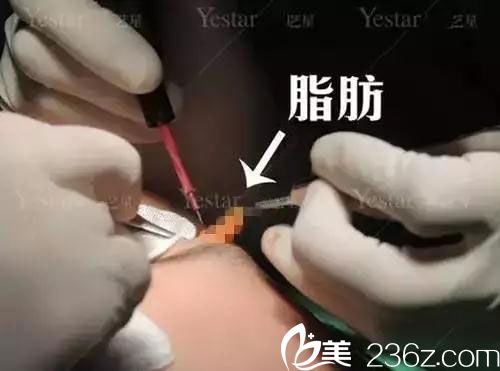 切开法双眼皮去脂过程 切开法双眼皮去脂过程