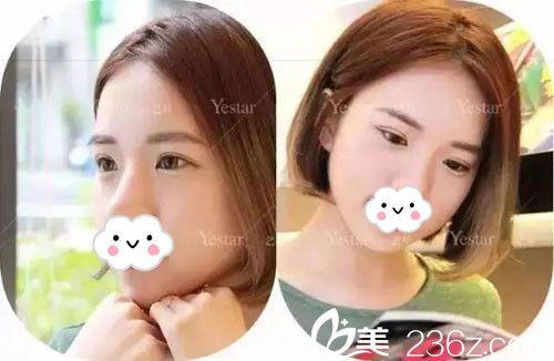 吕永全医生切开法双眼皮术后恢复 吕永全医生切开法双眼皮术后恢复