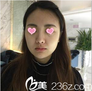 在北京米兰柏羽丽都注射丰唇前样子 在北京米兰柏羽丽都注射丰唇前样子