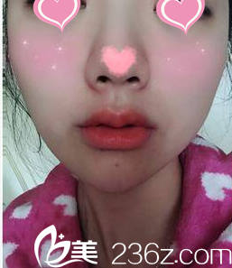 北京米兰柏羽丽都梁春霞注射丰唇案例 北京米兰柏羽丽都梁春霞注射丰唇案例