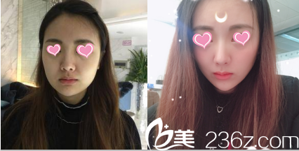 北京米兰柏羽丽都注射丰唇前后对比效果 北京米兰柏羽丽都注射丰唇前后对比效果