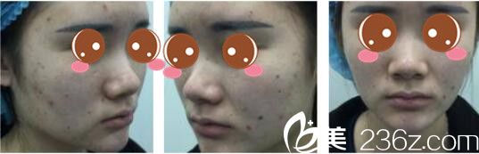 韩国奥拉克皮肤科整外科朴帝泳鼻综合真人术前照案例 韩国奥拉克皮肤科整外科朴帝泳鼻综合真人术前照案例