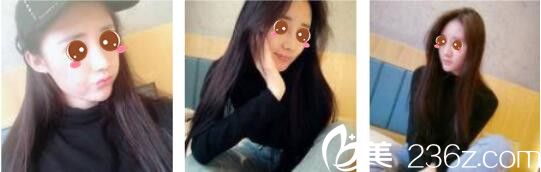 韩国奥拉克皮肤科整外科朴帝泳鼻综合真人案例术后十五天 韩国奥拉克皮肤科整外科朴帝泳鼻综合真人案例术后十五天