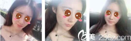 韩国奥拉克皮肤科整外科朴帝泳鼻综合真人案例术后一个月 韩国奥拉克皮肤科整外科朴帝泳鼻综合真人案例术后一个月