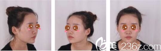 韩国奥拉克皮肤科整外科朴帝泳鼻修复真人案例术前照 韩国奥拉克皮肤科整外科朴帝泳鼻修复真人案例术前照