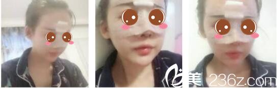 韩国奥拉克皮肤科整外科朴帝泳鼻修复真人案例术后第三天 韩国奥拉克皮肤科整外科朴帝泳鼻修复真人案例术后第三天