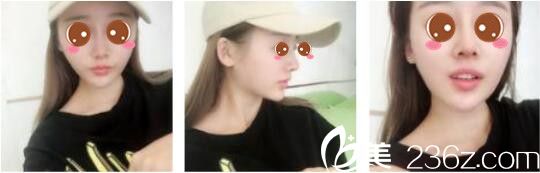 韩国奥拉克皮肤科整外科朴帝泳鼻修复真人案例术后一个月 韩国奥拉克皮肤科整外科朴帝泳鼻修复真人案例术后一个月