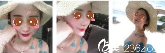 韩国奥拉克皮肤科整外科朴帝泳鼻综合真人案例术后二十二天 韩国奥拉克皮肤科整外科朴帝泳鼻综合真人案例术后二十二天