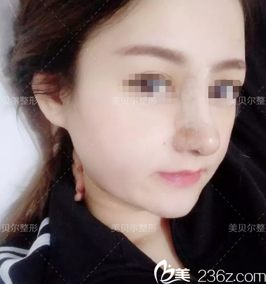 术后五天鼻综合恢复中