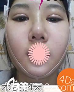 崔德浩院长给我做双眼皮+假体隆鼻+面部轮廓4天后的照片