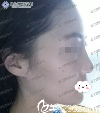 术前侧面照 术前侧面照