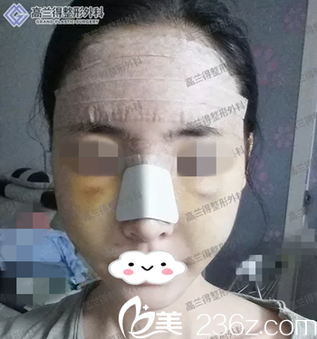 术后第二天 术后第二天