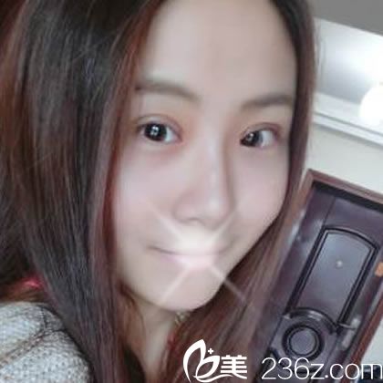 做完埋线双眼皮10天恢复照 做完埋线双眼皮10天恢复照