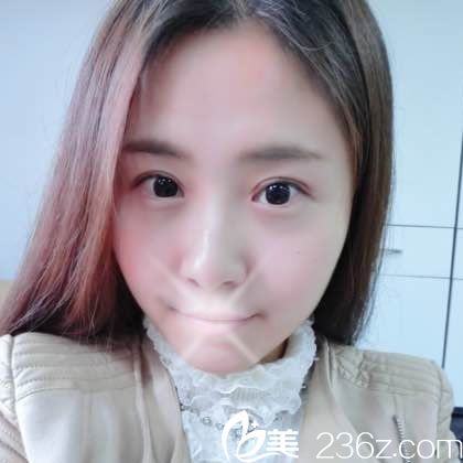 对不起,现在才来分享找温州芘丽芙美容医院金锋做埋线双眼皮的手术经历