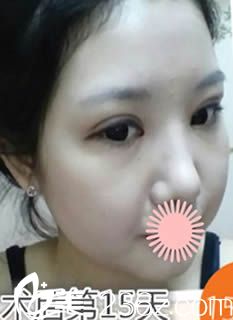 韩国GOODLINE崔德浩整形外科术后15天效果照