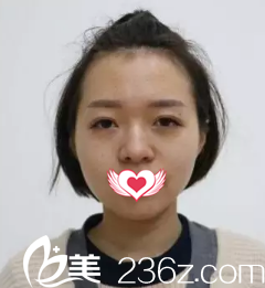 术前鼻子塌平 术前鼻子塌平