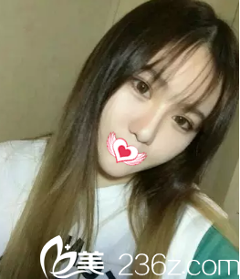 面部吸脂16天完全消肿 面部吸脂16天完全消肿