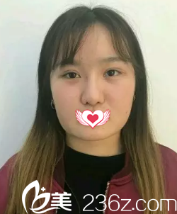 术前是大饼脸 术前是大饼脸