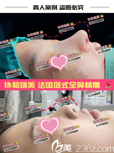 九江星瑞美隆鼻前后对比
