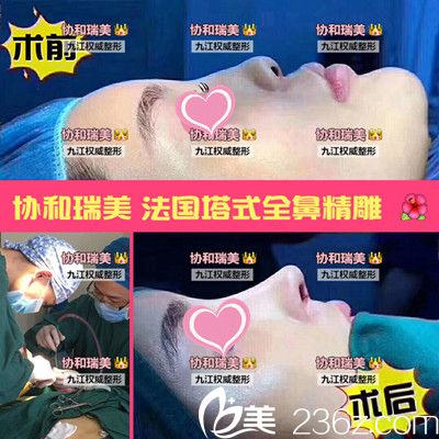 九江星瑞美隆鼻对比图