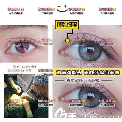 刘志强院长双眼皮手术案例