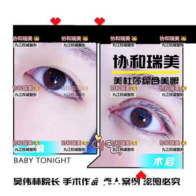 吴伟林院长双眼皮手术案例