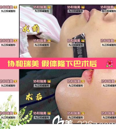 假体隆下巴案例