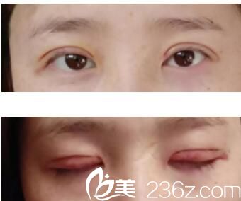 郑州至美双眼皮手术