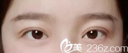 郑州至美双眼皮术后半个月