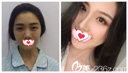 唐山苏亚美联臣隆鼻案例