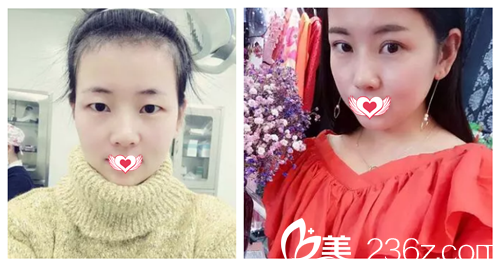 苏亚美联臣整形医院双眼皮案例