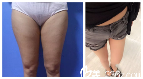 唐山苏亚美联臣吸脂案例