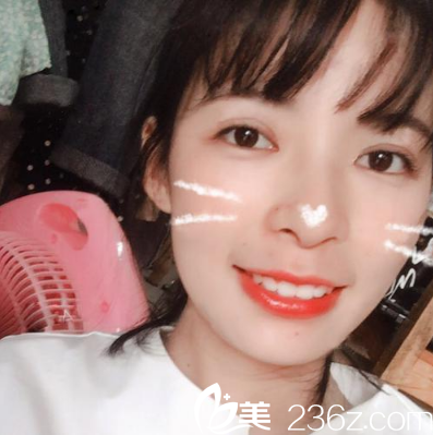 看妈妈陪我找珠海艾瑞整形美容医院祝小伟院长做的切开双眼皮好看吗