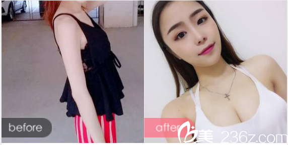 广州曙光整形医院郭建院长做的假体隆胸案例 广州曙光整形医院郭建院长做的假体隆胸案例