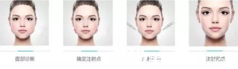 注射瘦脸理想中的效果