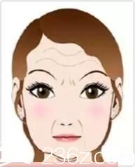 脸大的原因之四下垂型脸大