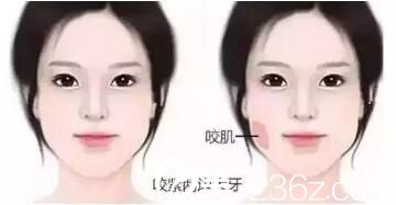 肌肉型脸大红色标注的是脸部咬肌