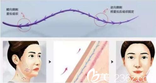 上海华美医疗美容医院面部埋线提升能维持多久？