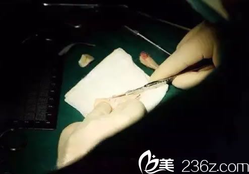 <!--<i data=20240703-sp></li>
<li><i data=20240703-sp></i>-->隆鼻手术雕刻软骨过程