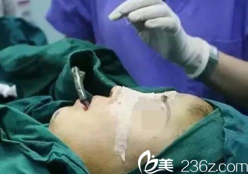 鼻综合隆鼻手术之缝合过程 鼻综合隆鼻手术之缝合过程