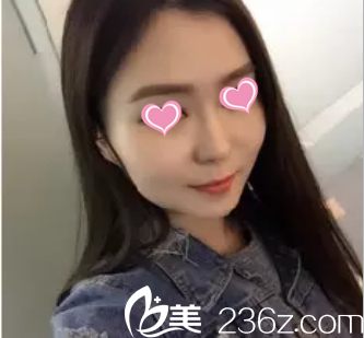 在北京米兰柏羽丽都注射瘦脸前样子 在北京米兰柏羽丽都注射瘦脸前样子