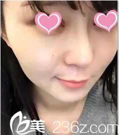 在北京米兰柏羽丽都注射瘦脸第3天效果 在北京米兰柏羽丽都注射瘦脸第3天效果