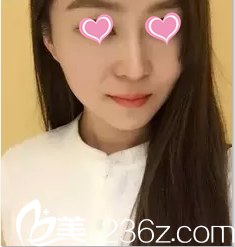 在北京米兰柏羽丽都注射瘦脸第11天效果 在北京米兰柏羽丽都注射瘦脸第11天效果