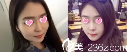 北京米兰柏羽丽都注射瘦脸前后对比效果 北京米兰柏羽丽都注射瘦脸前后对比效果