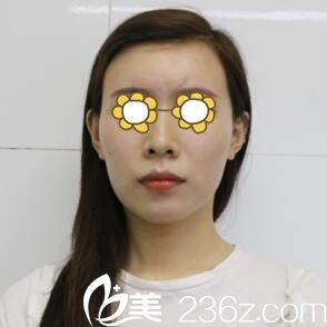 自体脂肪填充面部术前照 自体脂肪填充面部术前照