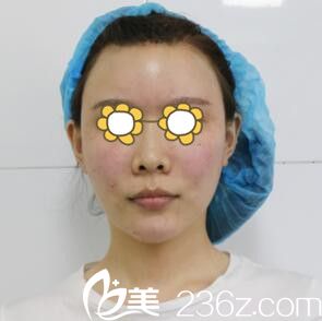 做自体脂肪填充面部当天效果 做自体脂肪填充面部当天效果