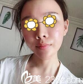 在长沙希美做自体脂肪填充面部术后一周 在长沙希美做自体脂肪填充面部术后一周